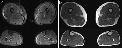 Colchicine Myopathy: A Case Series Including Muscle MRI and ABCB1 Polymorphism Data